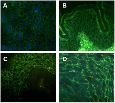 Identification of a Novel Non-desmoglein Autoantigen in Pemphigus Vulgaris